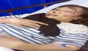 الحكم بسجن الجاني 10 أعوام.. حرقها زوجها بـ«ماء النار» - أخبار السعودية